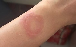 Người dùng Apple Watch phản ánh bị bỏng nặng và gặp khó khăn khi liên hệ hỗ trợ suốt 6 tháng