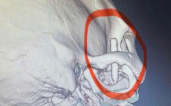 Chàng trai đau thái dương suốt 13 năm, bác sĩ phát hiện ra bí mật "đáng sợ" bên trong