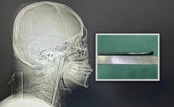 Người đàn ông sống 8 năm với chiếc đũa trong cổ họng và cái kết khiến cộng đồng mạng không thể tin nổi