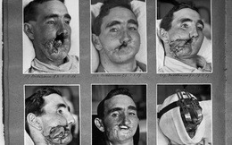 Câu chuyện bi thảm về hàng trăm phi công "chuột lang" trong thế chiến II và vị bác sĩ đã giúp họ tìm lại hình hài con người