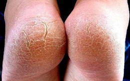 Đừng bỏ qua: 5 dấu hiệu ở bàn chân cảnh báo sức khỏe có vấn đề!