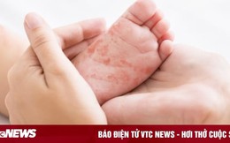 Bé gái 4 tuổi ở Hà Nội tử vong do mắc sởi