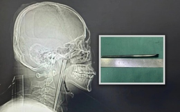 Người đàn ông sống 8 năm với chiếc đũa trong cổ họng và cái kết khiến cộng đồng mạng không thể tin nổi