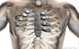 Vì sao cơ thể người luôn chấp nhận kim loại titan nhưng lại hoàn toàn bài xích thép không gỉ?