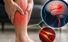 Chuyên gia cảnh báo: 5 dấu hiệu tại BẮP CHÂN có thể là tín hiệu cảnh báo đột quỵ, nếu thấy phải đi kiểm tra ngay