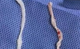 Đau cánh tay suốt một năm, người phụ nữ bàng hoàng khi bác sĩ phát hiện hai sinh vật dài 10cm đang sống dưới da