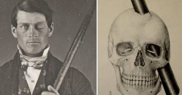 Phineas Gage and the accident that gave birth to modern neuroscience