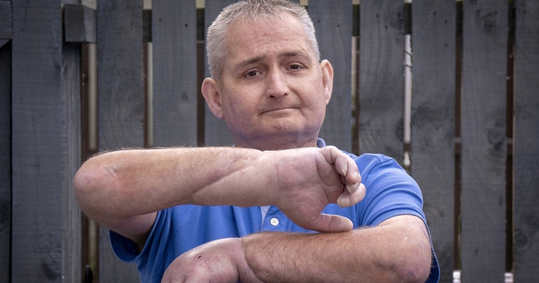 30 surgeons in 12 hours help man transplant a new hand