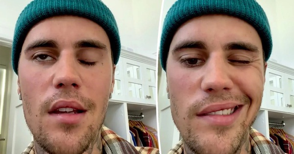 Justin Bieber has facial paralysis because of a strange but familiar syndrome, most of us have the same virus as him