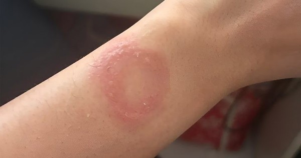 Người dùng Apple Watch bị bỏng nặng, vật lộn 6 tháng không được hỗ trợ