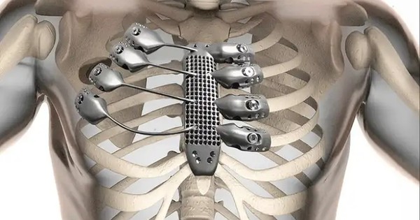 Tại sao cơ thể chấp nhận titan nhưng bài xích thép không gỉ?