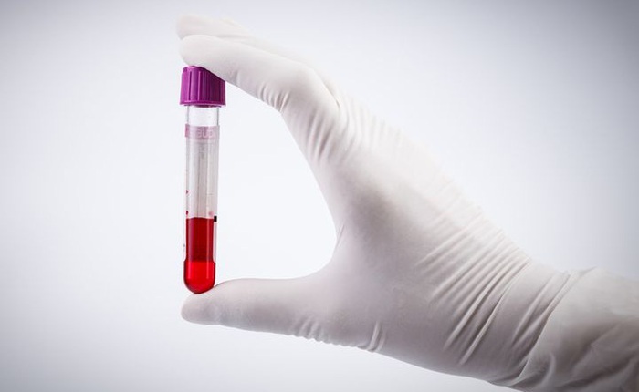 FDA Hoa Kỳ cho phép truyền huyết tương người khỏi bệnh để điều trị những ca Covid-19 nguy kịch nhưng cấm dùng với người khỏe