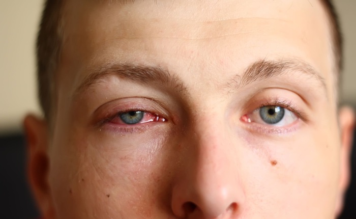 Viện Nhãn khoa Hoa Kỳ: Mắt đỏ nhẹ có thể là dấu hiệu của bệnh nhân nhiễm COVID-19