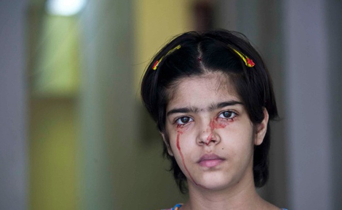 Giải mã bí ẩn của haemolacria: "Chứng bệnh" khiến những cô gái Ấn Độ khóc ra máu
