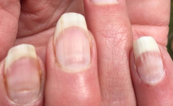 Nhiều bệnh nhân COVID-19 có vệt lõm này trên móng tay, liệu nó sẽ có ích trong việc sàng lọc bệnh?