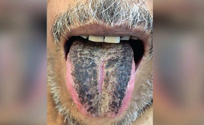 Kỳ lạ người đàn ông Ấn Độ mọc đầy lông đen trên lưỡi