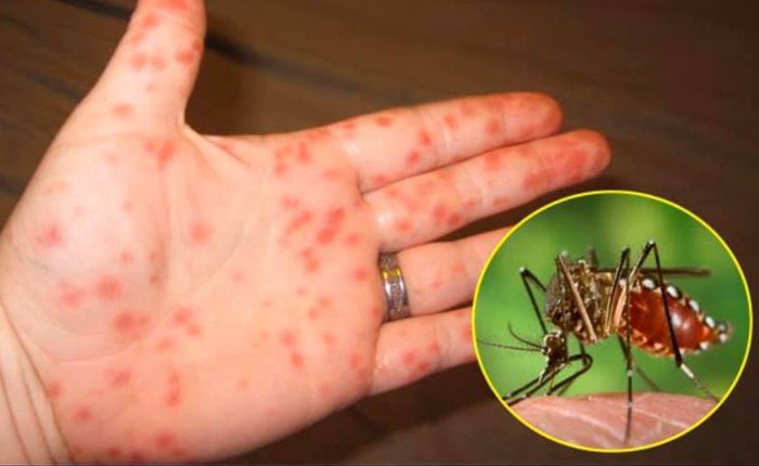 Dịch sốt xuất huyết bùng phát, thử ngay 4 món đuổi muỗi cực lành tính này để phòng ngừa
