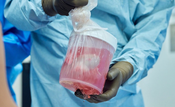 Đột phá: Các bác sĩ Mỹ ghép thận lợn sang người và ước mơ về một nguồn cung nội tạng vô tận