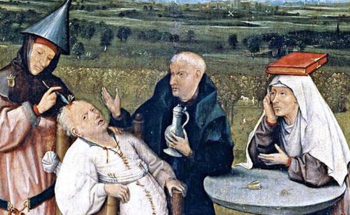 Trepanation: Thủ tục phẫu thuật sọ lâu đời nhất thế giới vẫn tồn tại đến ngày nay!