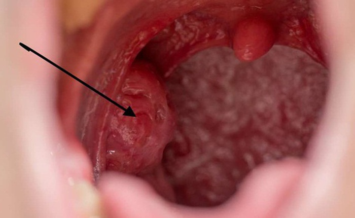 Người đàn ông bất ngờ phát hiện mắc ung thư ở miệng, vì chủng virus anh nghĩ chỉ lây nhiễm tử cung phụ nữ