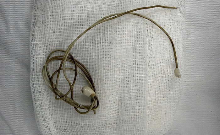 Dây sạc điện thoại nằm trong bàng quang của nam sinh sau khi học theo clip trên mạng