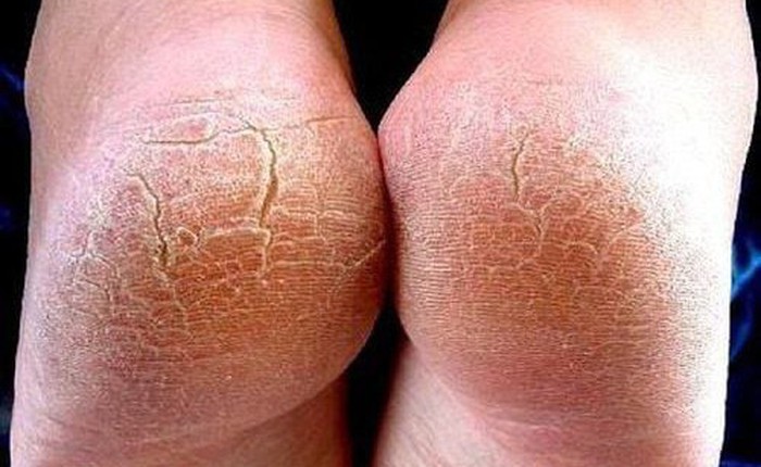 Đừng bỏ qua: 5 dấu hiệu ở bàn chân cảnh báo sức khỏe có vấn đề!