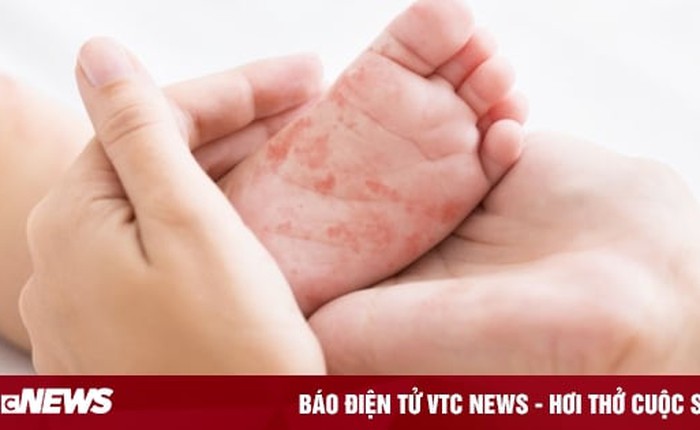 Bé gái 4 tuổi ở Hà Nội tử vong do mắc sởi