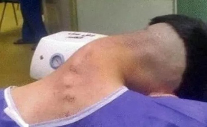 Nam thanh niên 23 tuổi mắc 'hội chứng đầu gục' do lạm dụng chất gây nghiện kéo dài