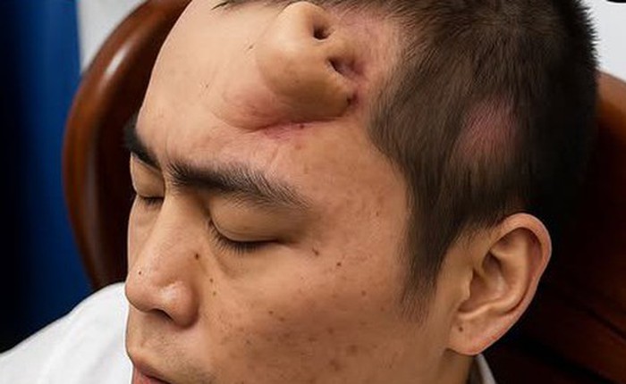 Không phải ảnh lỗi của AI, người đàn ông này đã thực sự mọc một chiếc mũi trên trán: Đó là "tác phẩm" của các bác sĩ Trung Quốc