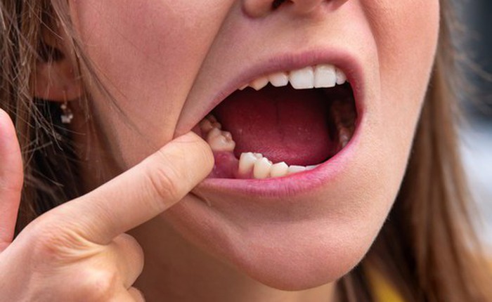 Nhật Bản thử nghiệm thuốc mọc lại răng cho người lớn, dự kiến 2030 sẽ bán ra