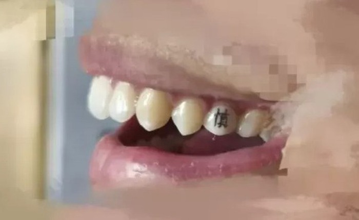 Chán hình xăm trên da, giới trẻ Trung Quốc chuyển sang xăm răng