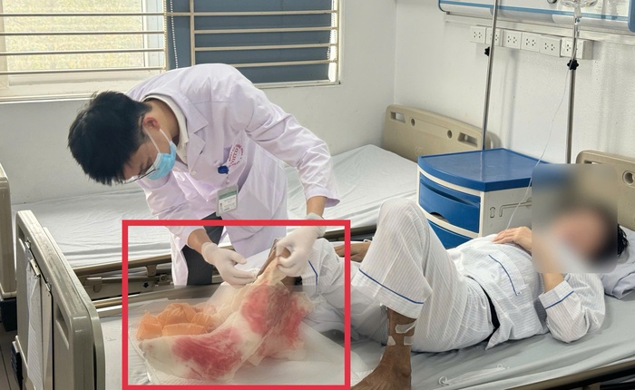 Đắp lá chữa bỏng suốt 1 tháng theo kinh nghiệm dân gian, người đàn ông suýt mất chân vì hoại tử lan đến xương