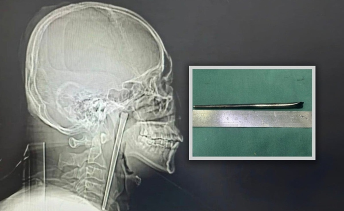 Người đàn ông sống 8 năm với chiếc đũa trong cổ họng và cái kết khiến cộng đồng mạng không thể tin nổi