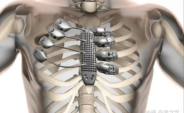 Vì sao cơ thể người luôn chấp nhận kim loại titan nhưng lại hoàn toàn bài xích thép không gỉ?