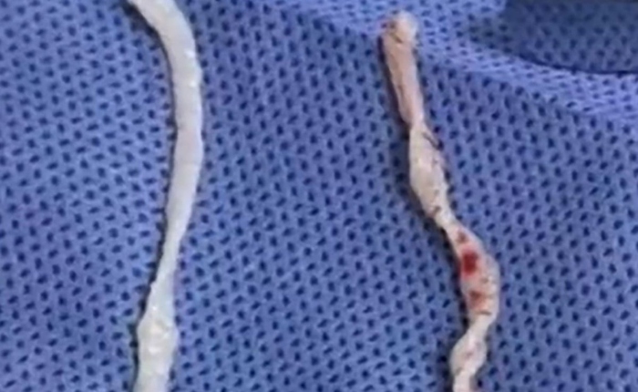 Đau cánh tay suốt một năm, người phụ nữ bàng hoàng khi bác sĩ phát hiện hai sinh vật dài 10cm đang sống dưới da