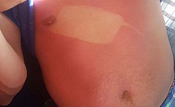 Ngủ quên khi tắm nắng, người đàn ông này nhận được "hình xăm" iPhone gần ngực khi thức dậy
