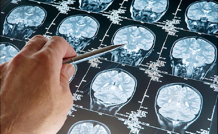 Phát hiện đột phá giúp điều trị ung thư và các bệnh về não