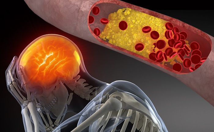 Cholesterol cao rất nguy hiểm, đây là 10 lời khuyên giúp bạn phòng tránh