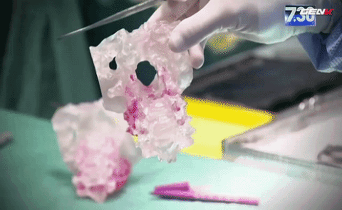 [Video] Lần đầu tiên các bác sĩ cấy ghép thành công đốt sống cổ in 3D