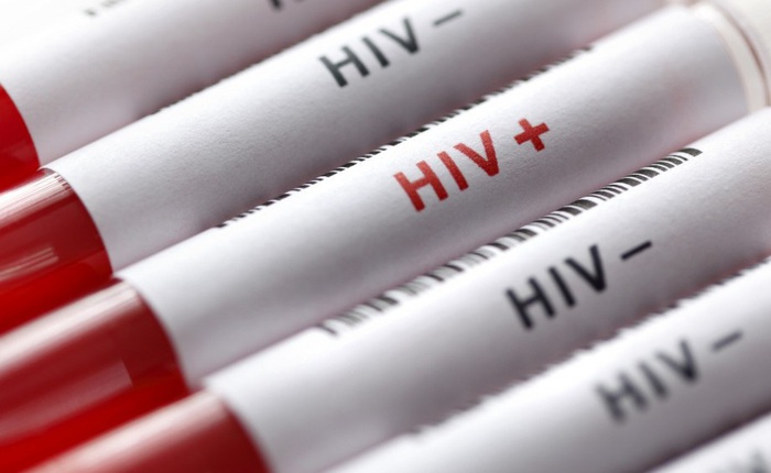 Nhiều người Nga coi HIV/AIDS là trò bịp bợm của truyền thông Phương Tây, dịch bệnh bùng phát mạnh