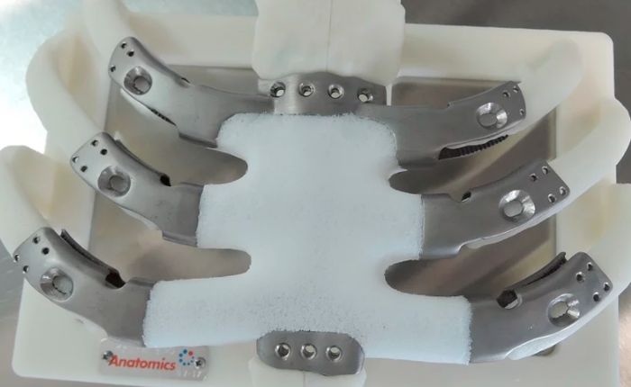 Lần đầu tiên ghép xương ức in 3D bằng titan cho bệnh nhân ung thư tại Mỹ