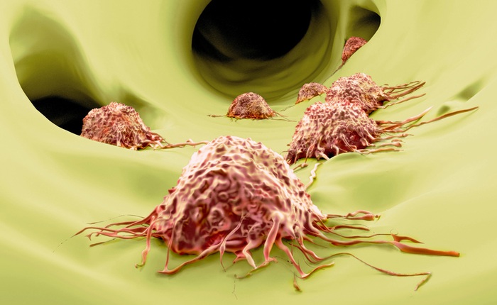 Các nhà khoa học Mỹ tìm ra con đường ngăn không cho ung thư di căn