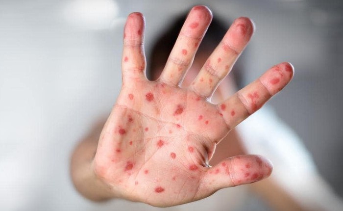 Phong trào "anti-vaccine" khiến dịch sởi quay lại tấn công Châu Âu và nước Mỹ