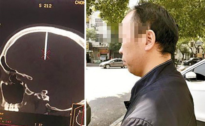Nhập viện vì đau đầu không rõ lý do, người đàn ông Trung Quốc mới biết cây đinh dài 4,8cm đã cắm vào hộp sọ