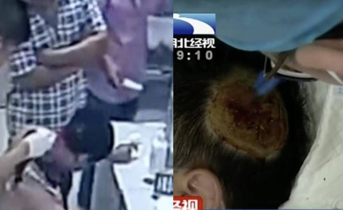 Trung Quốc: Sạc dự phòng để dưới gối bất ngờ phát nổ, thổi bay  mảng da đầu của người đàn ông đang ngủ