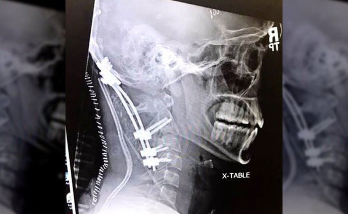 Chàng trai 22 tuổi gây chấn động y học vì sống sót sau tai nạn "suýt rụng đầu"