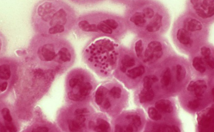 Ca nhiễm siêu vi khuẩn lậu không chữa khỏi đầu tiên ở Anh vừa được báo cáo