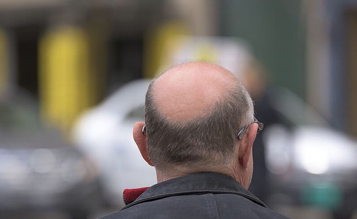 Nghiên cứu cho thấy ô nhiễm không khí có thể khiến bạn bị hói đầu