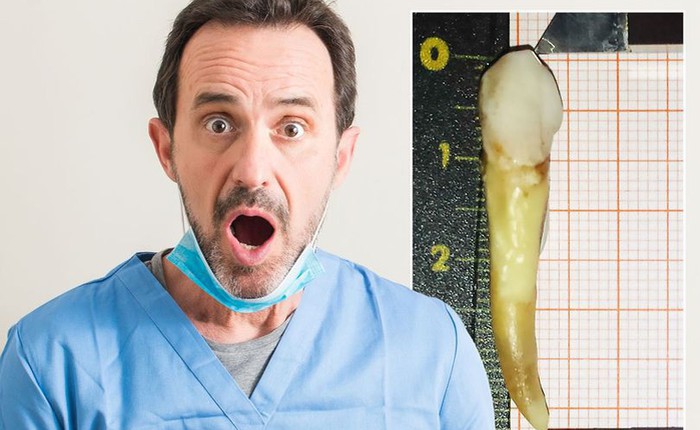 Người đàn ông đi vào Sách kỷ lục Guiness vì sở hữu chiếc răng dài gần 4cm