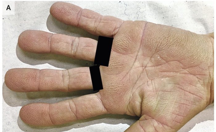 Dấu hiệu vân nhăn kỳ lạ trong lòng bàn tay thể hiện nguy cơ bệnh ung thư tiềm ẩn